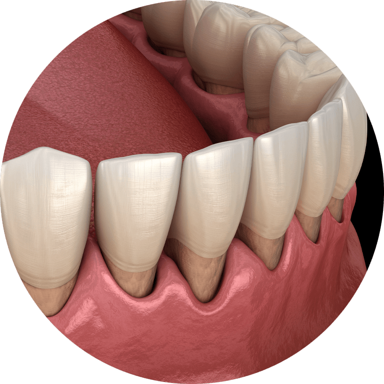 gum recession graphic