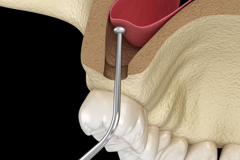 sinus lift graphic