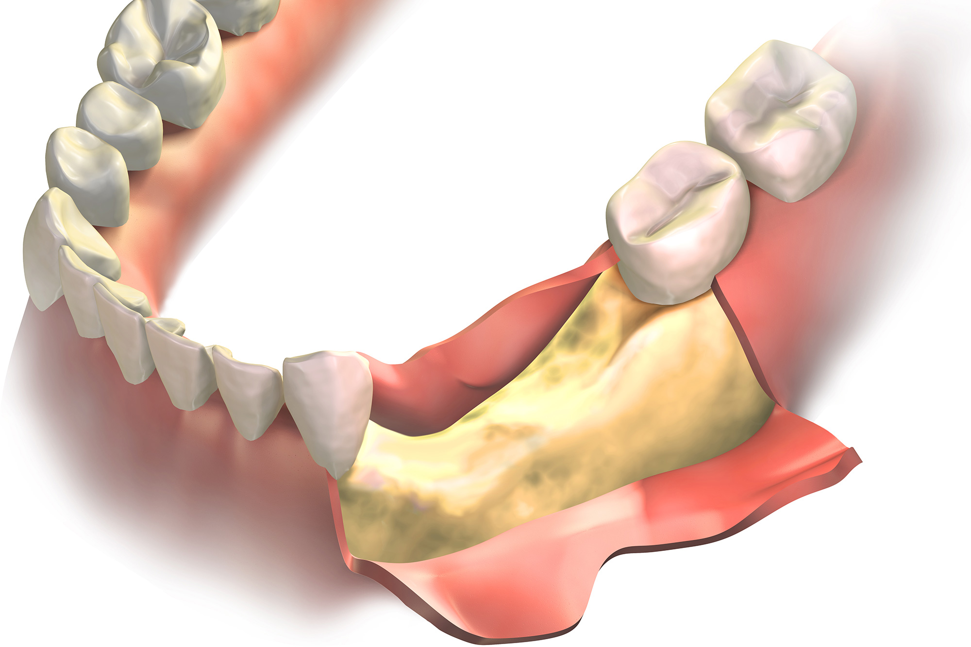 Bone Graft Arkansas Periodontal & Implant Associates