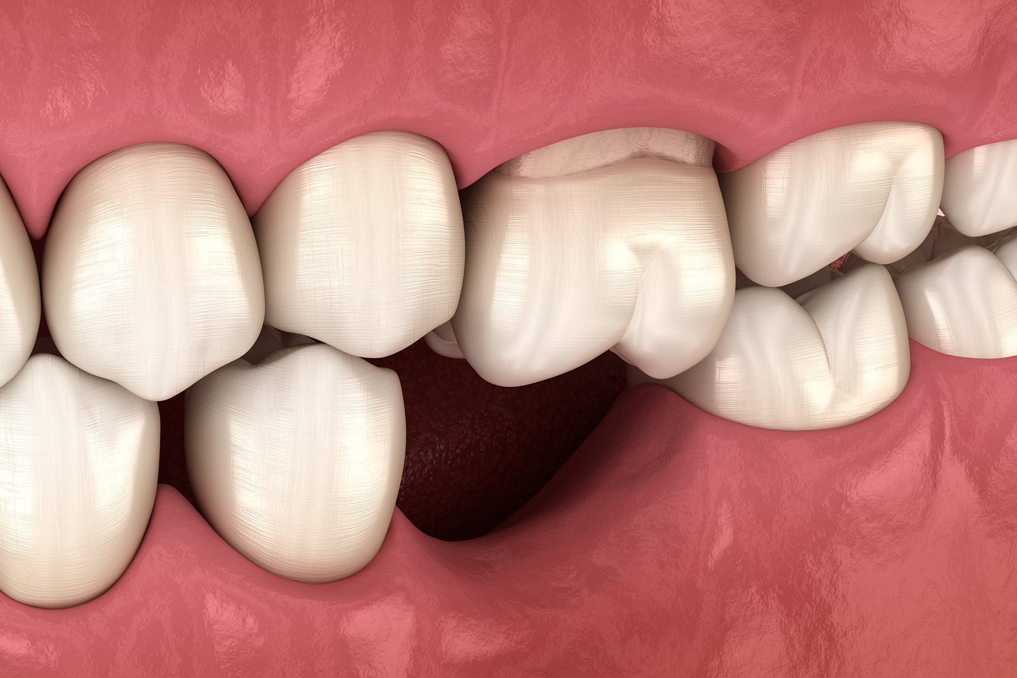 Tooth and Bone Loss Arkansas Periodontal & Implant Associates