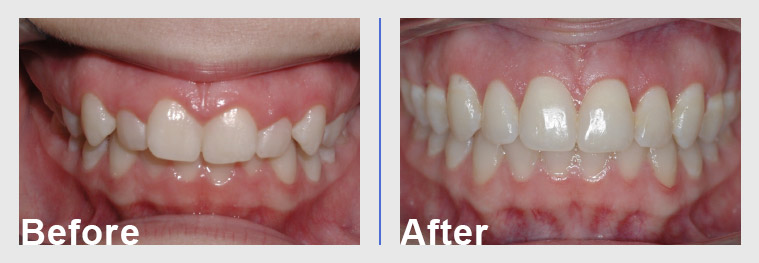 Crown lenthening before and after