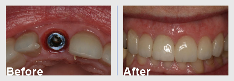Dental implant before and after Arkansas Periodontal & Implant Associates