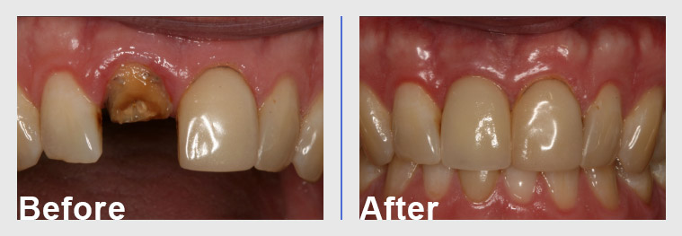 Dental implant before and after Arkansas Periodontal & Implant Associates