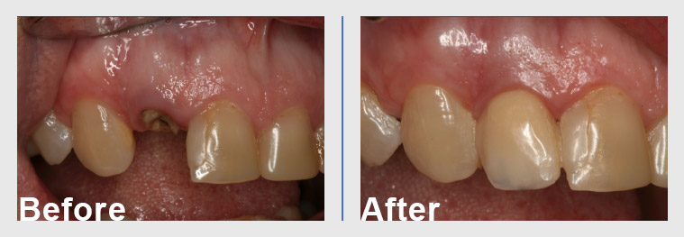 Dental implant before and after Arkansas Periodontal & Implant Associates