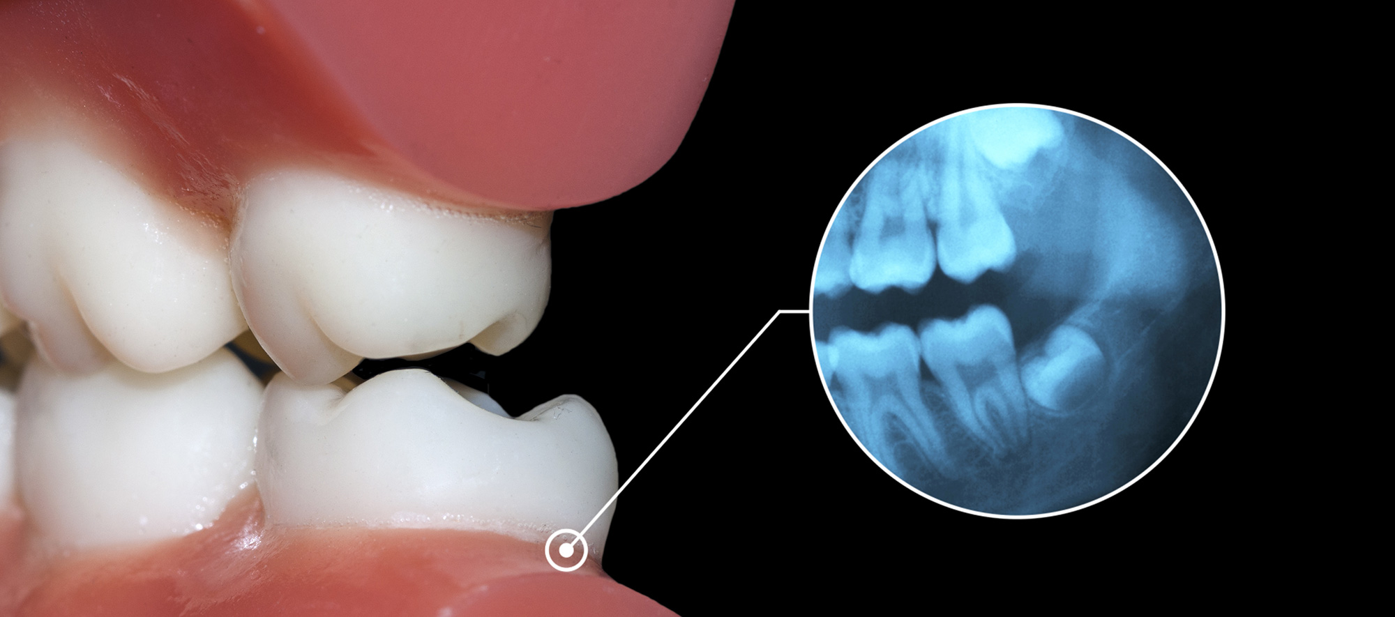 Occlusal Adjustment Arkansas Periodontal & Implant Associates