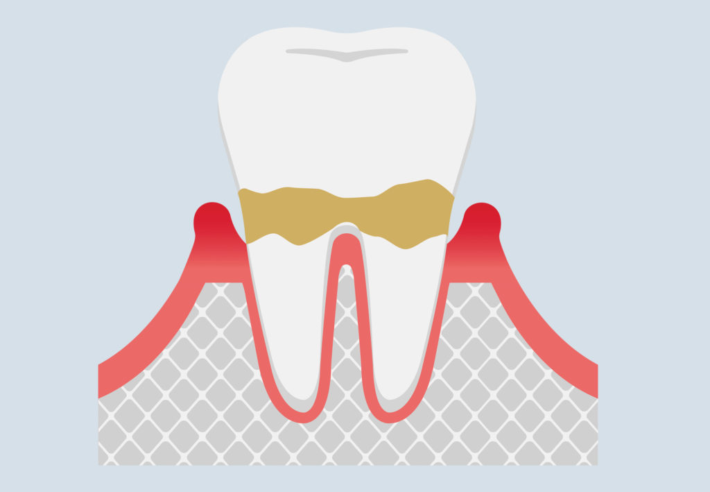 Periodontitis Arkansas Periodontal & Implant Associates