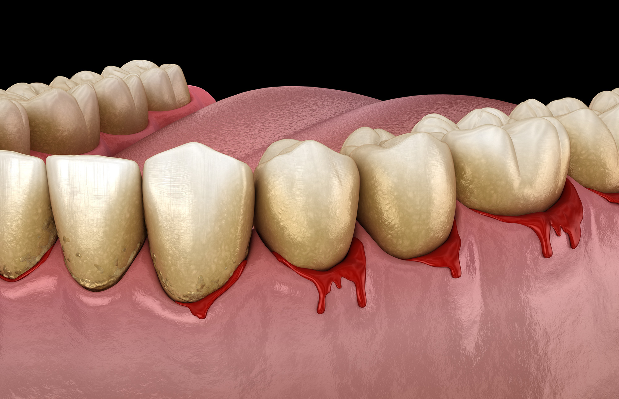 bleeding gums Arkansas Periodontal & Implant Associates